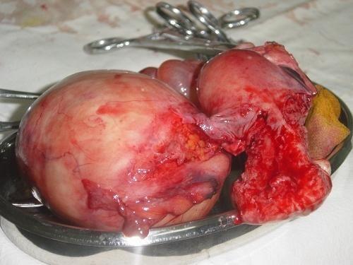 畸胎瘤什么样子图片图片