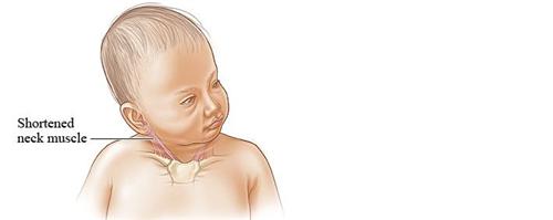 先天性斜颈婴儿图片