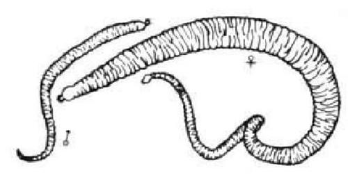 肺部粪类圆线虫病