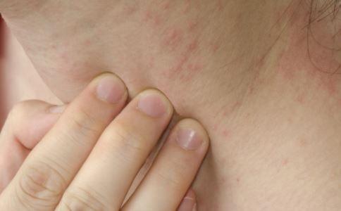 亚急性湿疹症状图片图片