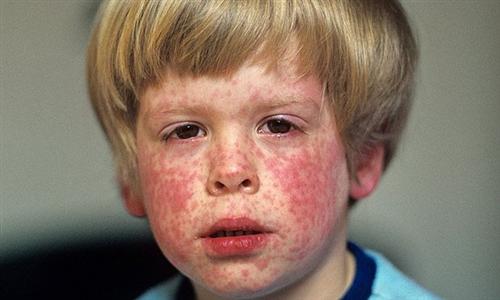 小孩起麻疹的症状图片图片