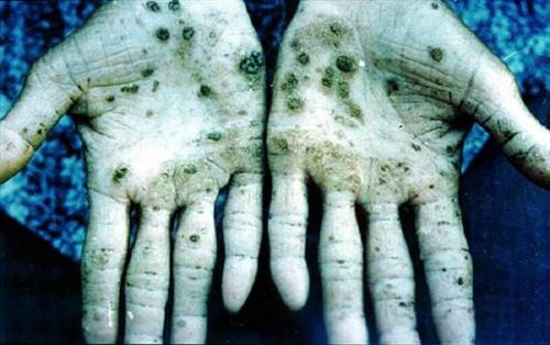 砷中毒砒霜图片