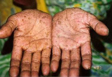 慢性砷中毒皮肤图片图片