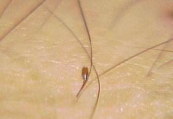 阴虱卵在毛囊里有多深图片