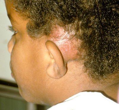 小孩乳突炎的症状图片图片
