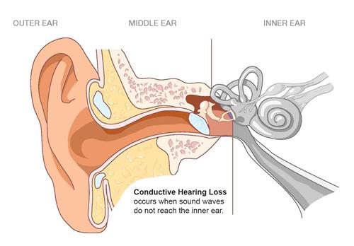 传导性耳鸣图片