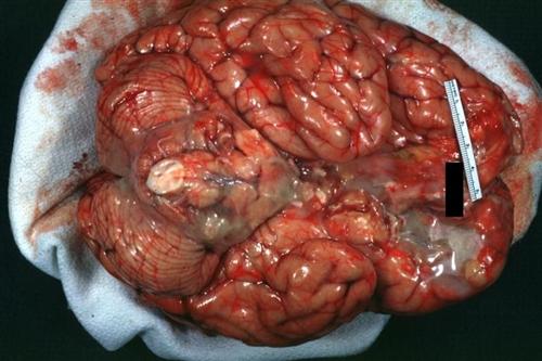 葡萄膜大脑炎图片