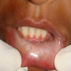 口腔粘膜病变会引起什么症状