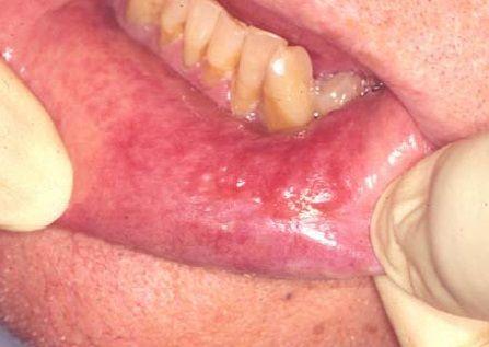 口腔黏膜炎什么症状图片