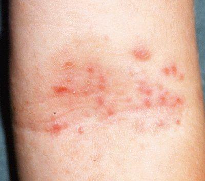 双膝盖湿疹是什么原因图片