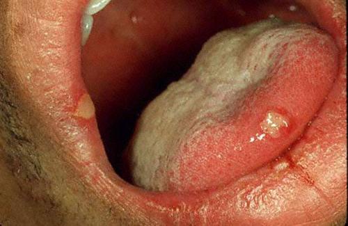 疱疹性咽峡炎高发期图片