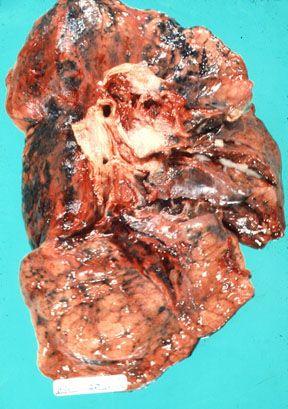 肺部有肿瘤可以活多久图片
