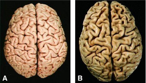正常大脑和脑萎缩图片图片