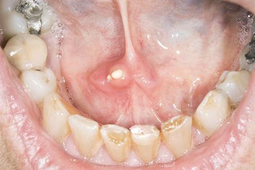 舌下囊肿磨损牙瘤慢性牙髓炎口腔炎复发性阿弗他溃疡唇癌慢性牙周炎