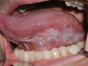 舌头白斑最初期的图片图片