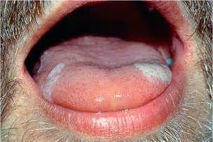 舌头白斑最初期的图片图片