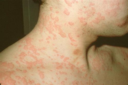 荨麻疹的症状后期图片