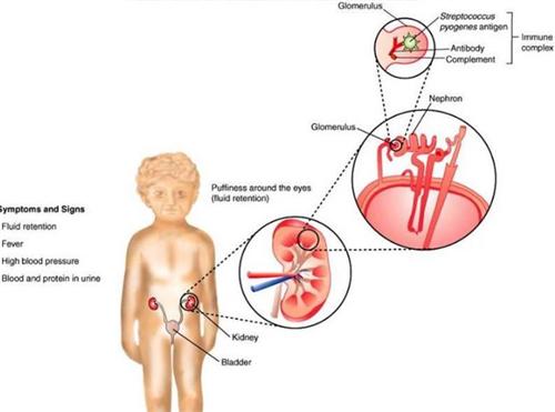 链球菌感染后的急性肾小球肾炎