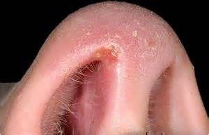 鼻前庭炎可以并发哪些疾病?