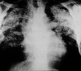 尘肺病标准图片 高清图片