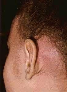 中耳乳突炎图片真人图片