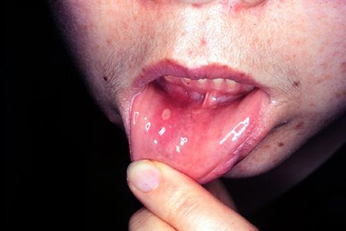 唇部带状疱疹图片