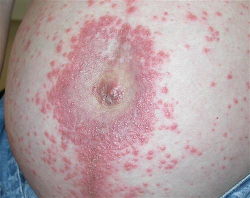 妊娠湿疹的症状图片图片