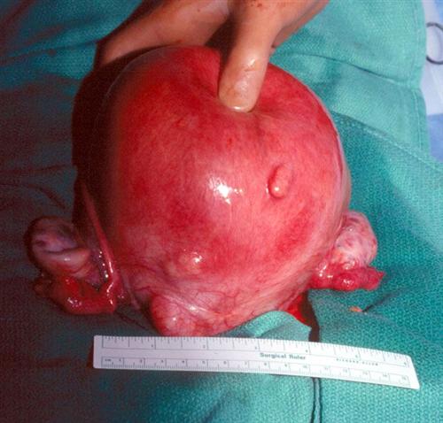 子宫后壁肌瘤图片