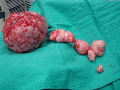 子宫腺肌瘤图片 真实图片