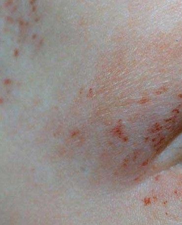 小肠过敏性紫癜