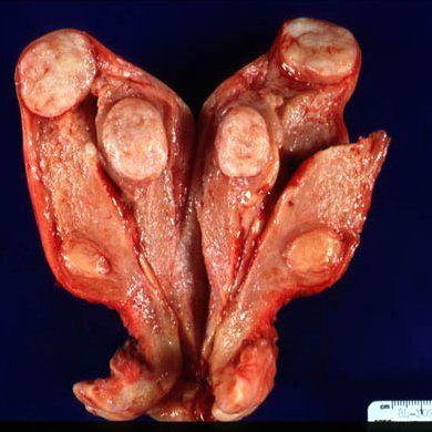 子宫平滑肌瘤手绘图图片