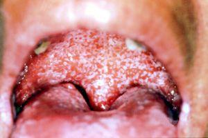 急性假膜型念珠菌口炎