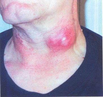 急性淋巴管炎症状图片图片