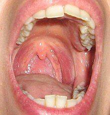 女性咽喉炎图片图片
