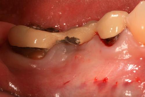 慢性根尖牙周炎图片图片