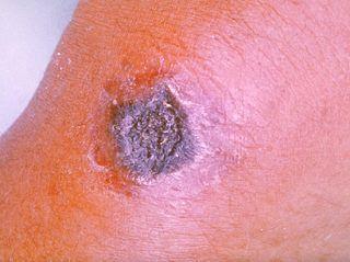 皮肤炭疽传播途径有哪些