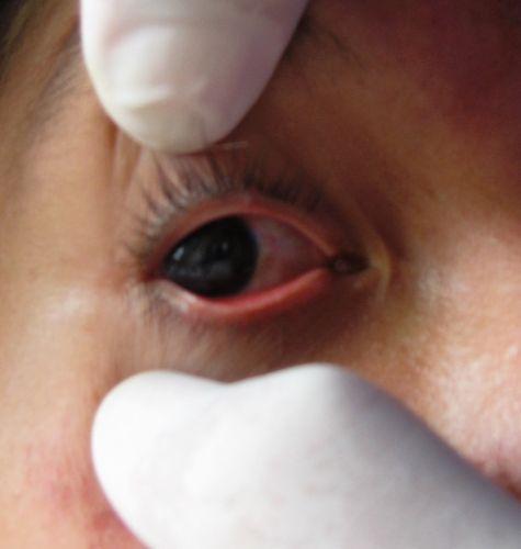单纯疱疹性眼睑炎图片图片