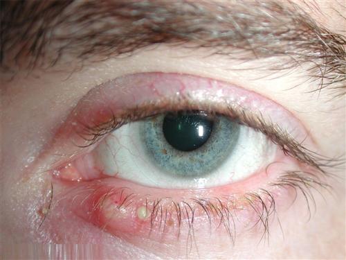 眼睑炎的症状图片