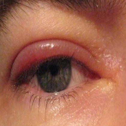 睑腺炎初期图片眼睑图片