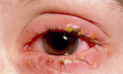 眼膏吗蠕形螨睑缘炎怎么治疗眦部睑缘炎是怎么引起的睑缘炎的早期症状