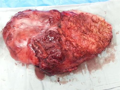 胸壁脂肪瘤图片图片