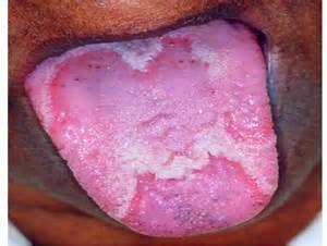 严重慢性咽炎舌头图片图片