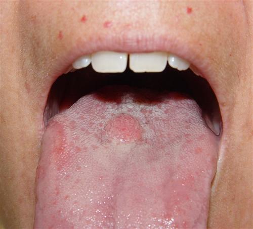 舌头炎症有什么症状图片