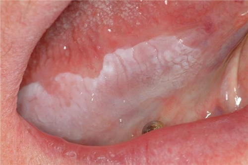 口腔白斑早期图舌头图片