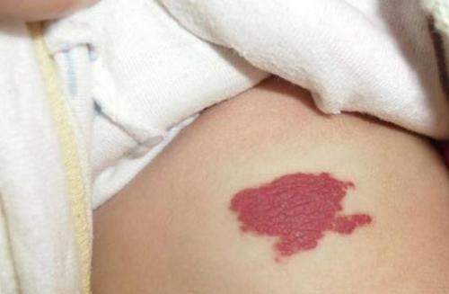 婴儿后颈部鲜红斑痣图片