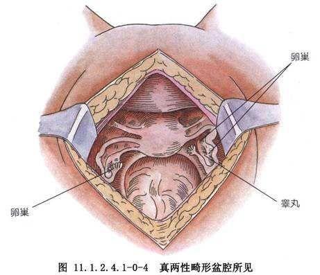 真两性畸形的症状是怎样的?