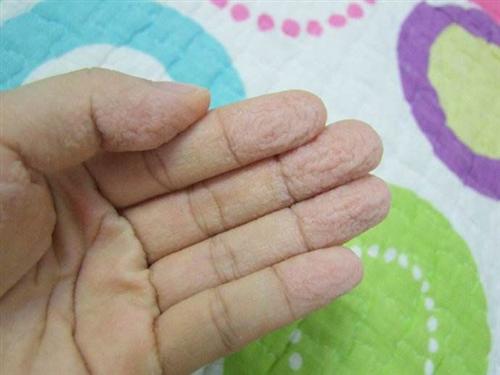 湿毒疮