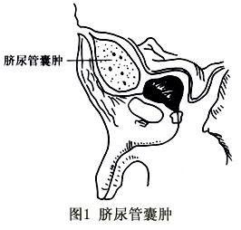 脐尿管位置图详细图片
