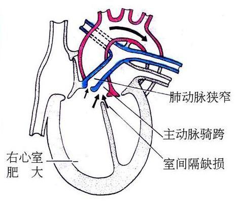 主动脉肺动脉间隔缺损图片