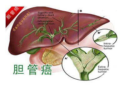 胆管肿瘤